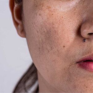 MELASMA E MANCHAS
