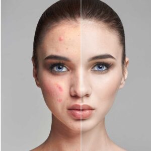 ROSACEA